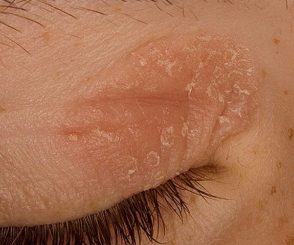 Eczema on Eyelids: Types