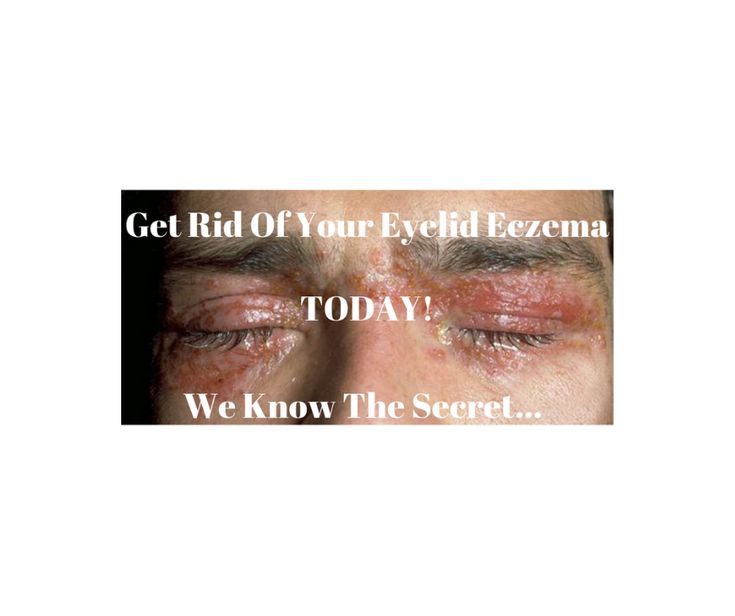 Eczema On Eyelids