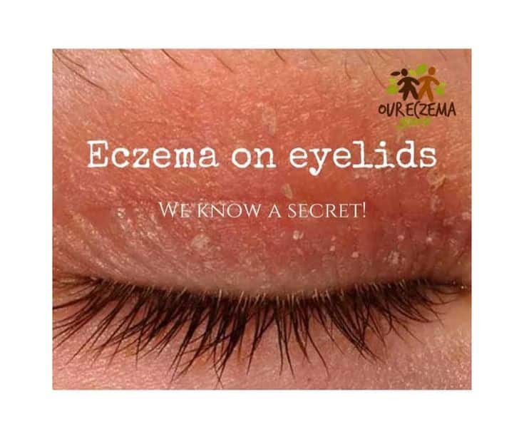 Eczema On Eyelids