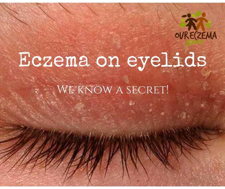 Eczema on eyelids, what are the causes and how can you treat it. Eczema ...