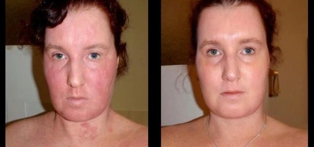 Eczema On Face Adults Treatment
