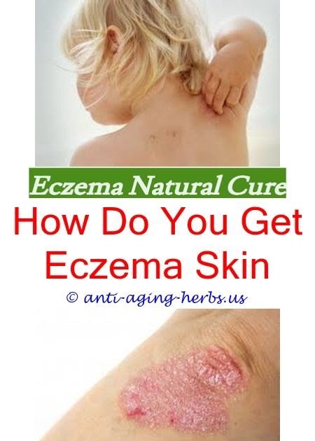 eczema on face cure tea tree oil for eczema on scalp ...