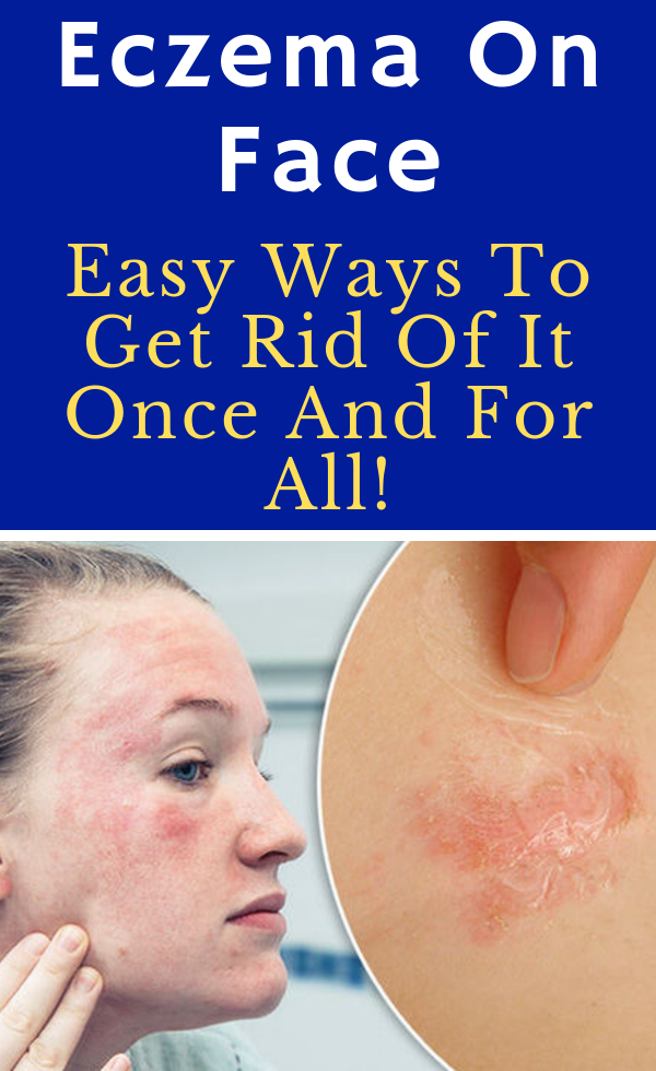Eczema On Face