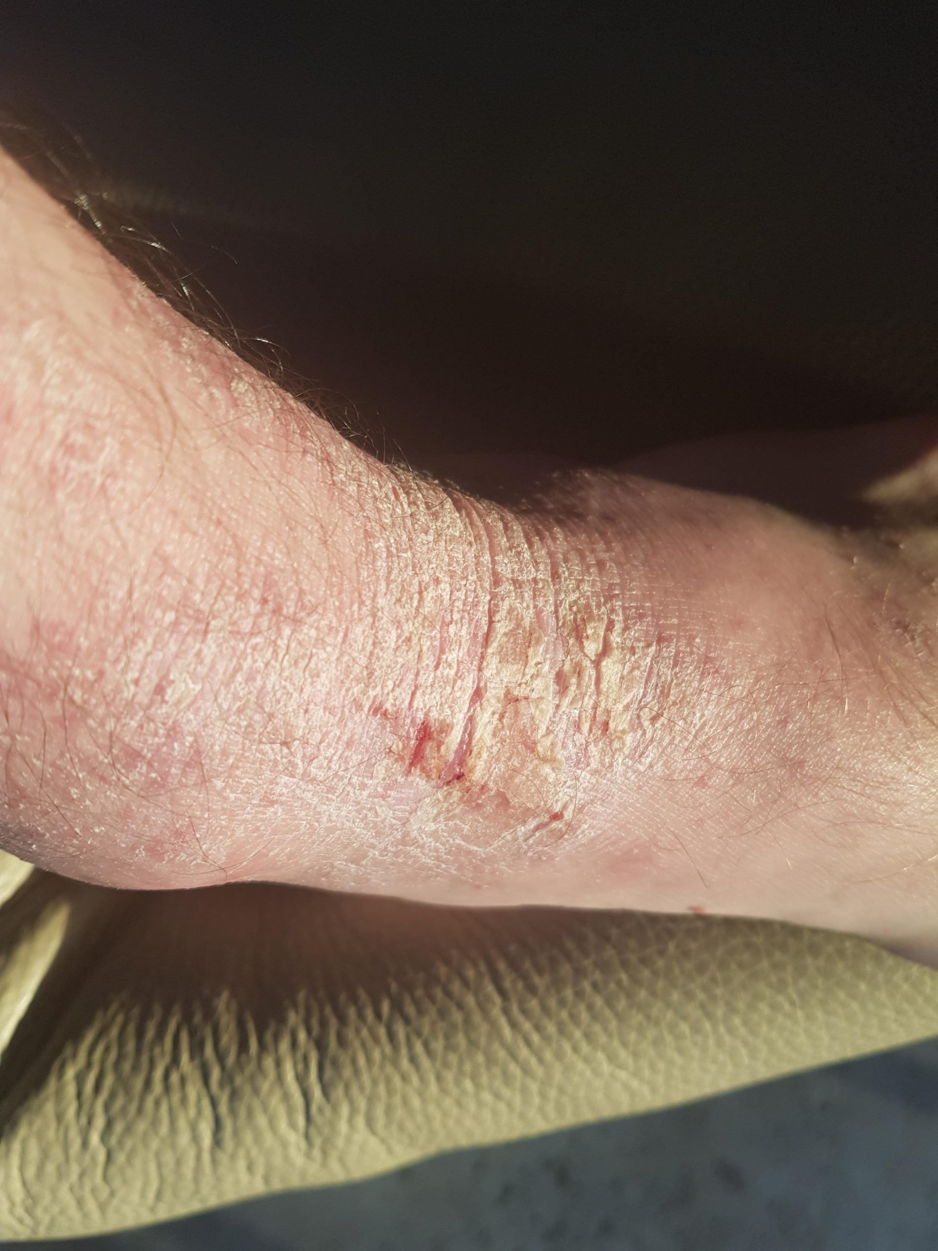 Eczema on feet from excessive heat/sweat : eczema