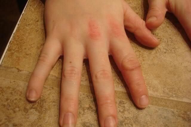 Eczema on hands can be pretty tough at time when trying to ...