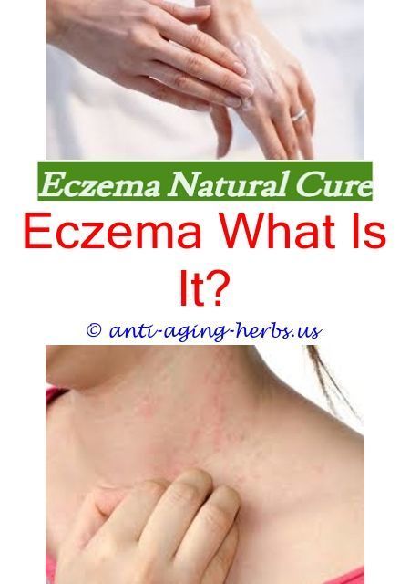 eczema on hands neosporin eczema cvs
