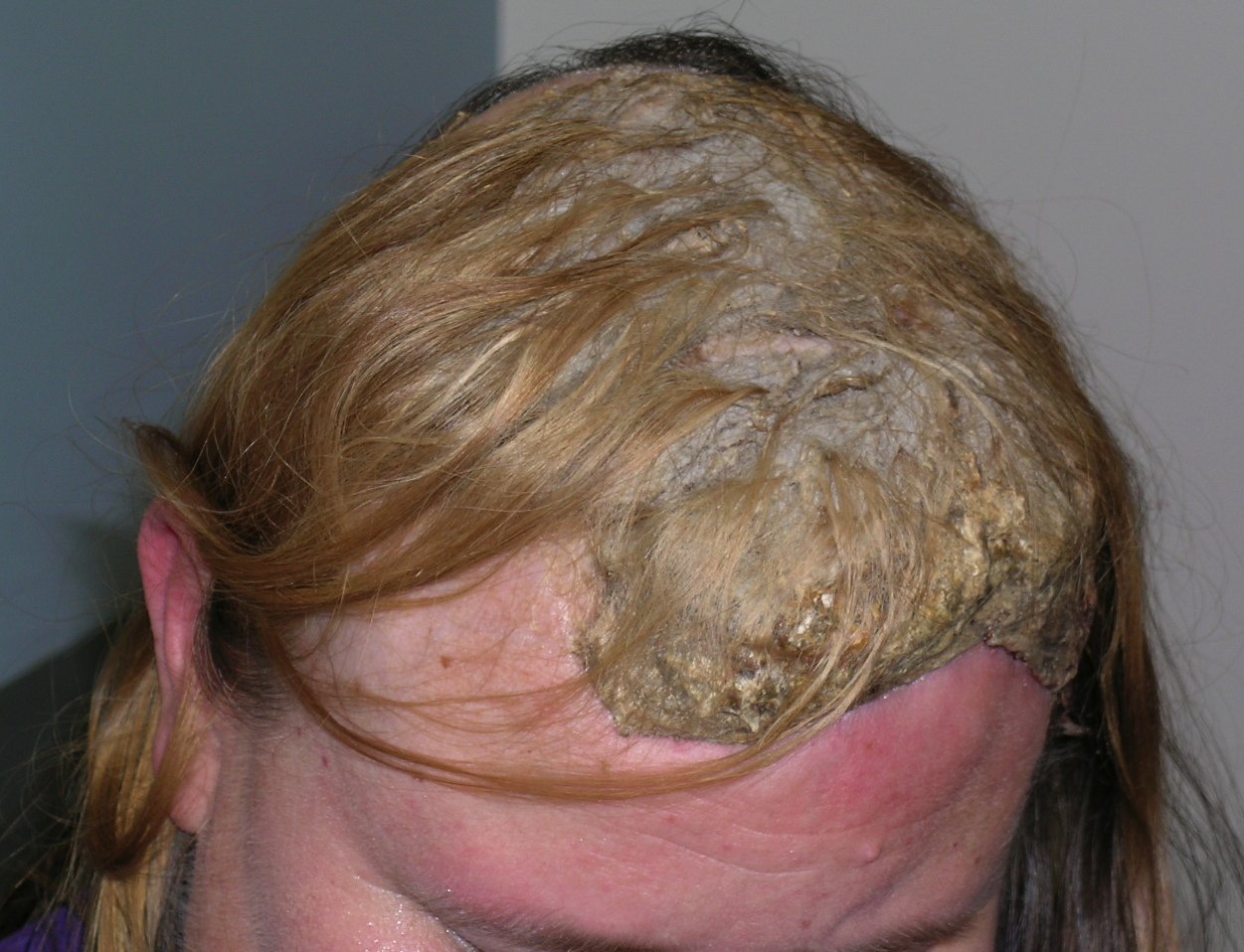 Eczema On Head Hair Loss / Seborrheic Dermatitis In Children National ...