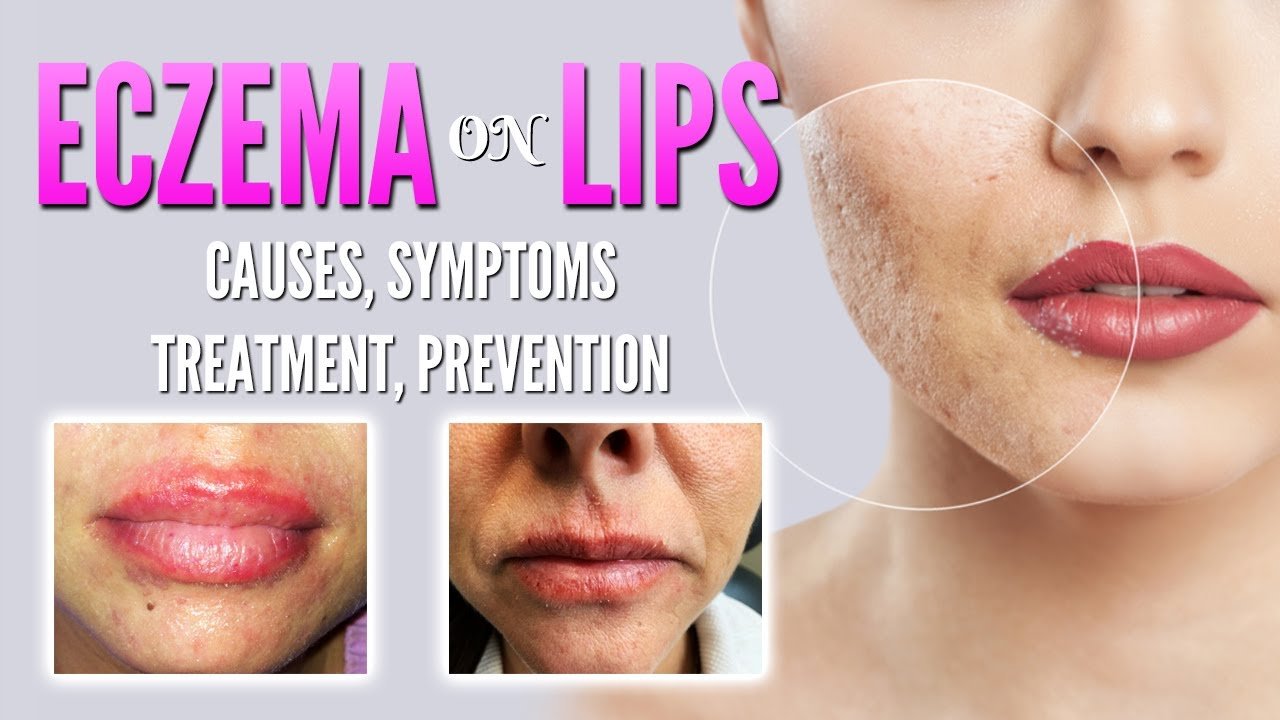 Eczema on lips causes, symptoms, treatment, remedies ...