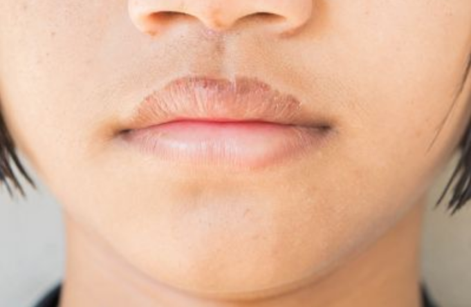 Eczema on Lips Meaning, Symptoms, Causes, Treatment and ...