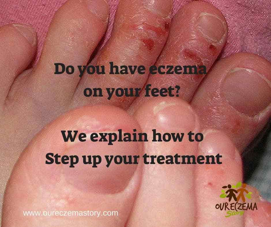 Eczema On My Feet