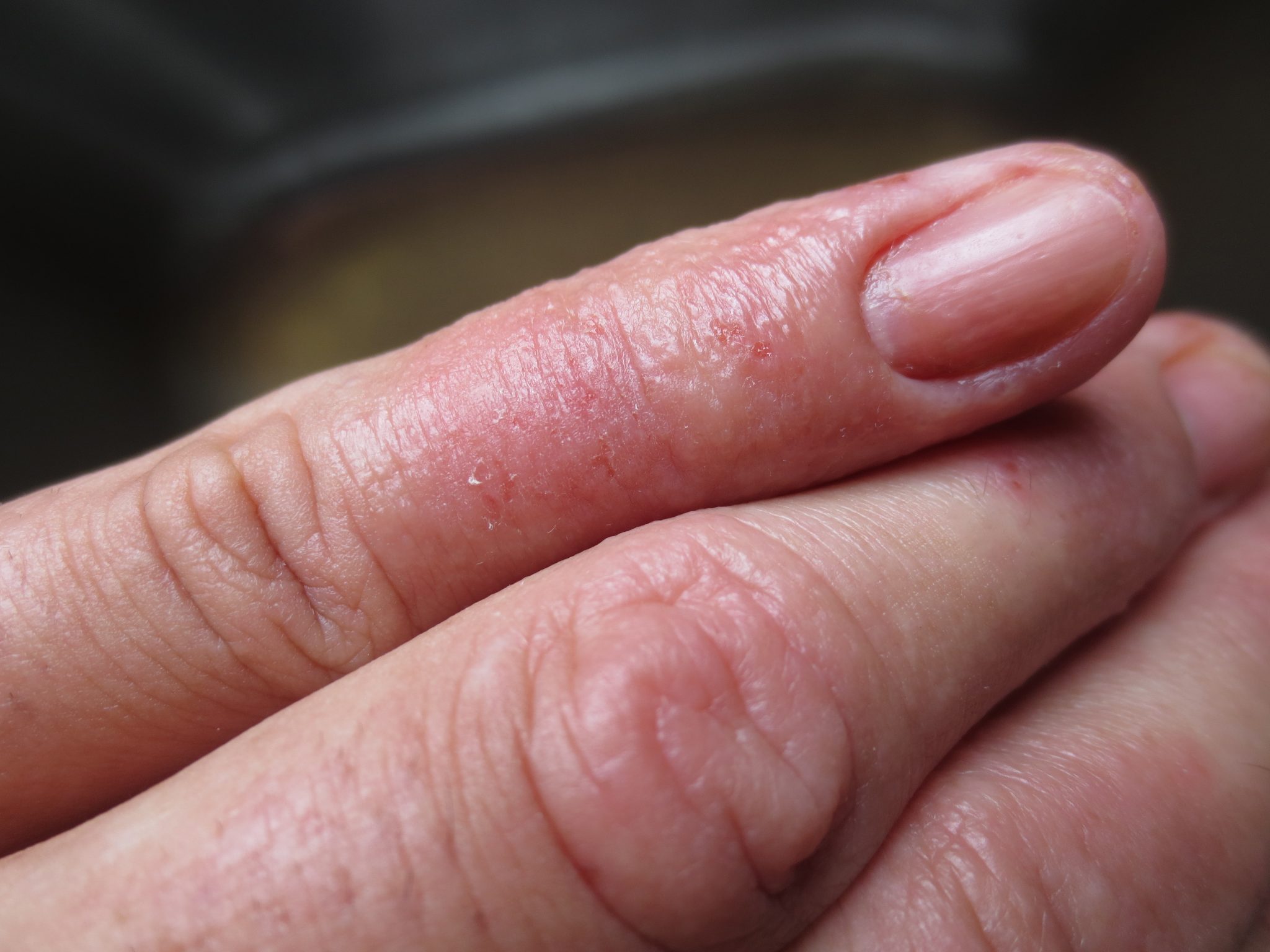Eczema on One Finger