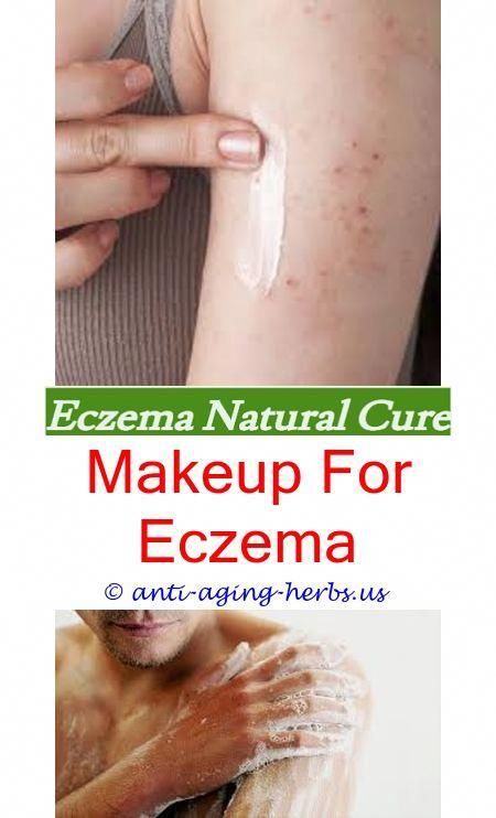 Eczema on palms and fingers.Eyelid eczema hydrocortisone.How long does ...