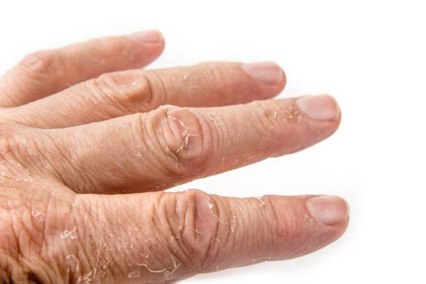 Eczema On Palms Stock Photos, Pictures &  Royalty