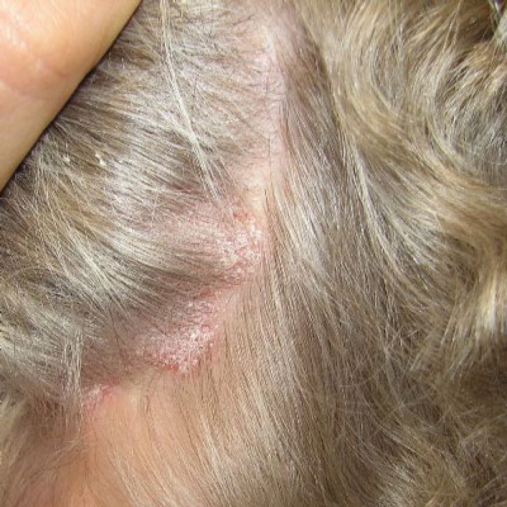 Eczema on Scalp