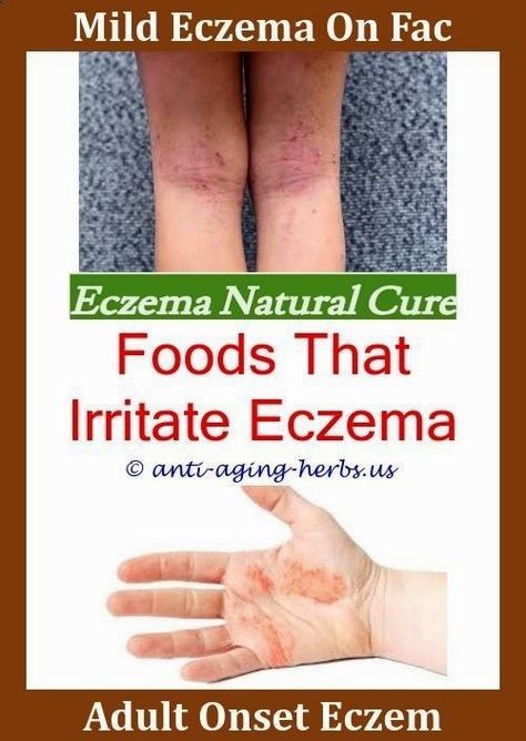 Eczema On Scalp Pompholyx Eczema Remedies,eczema dermatitis treatment ...