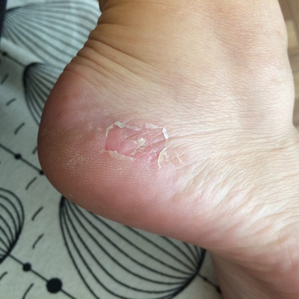 Eczema On Soles Of Feet Pictures