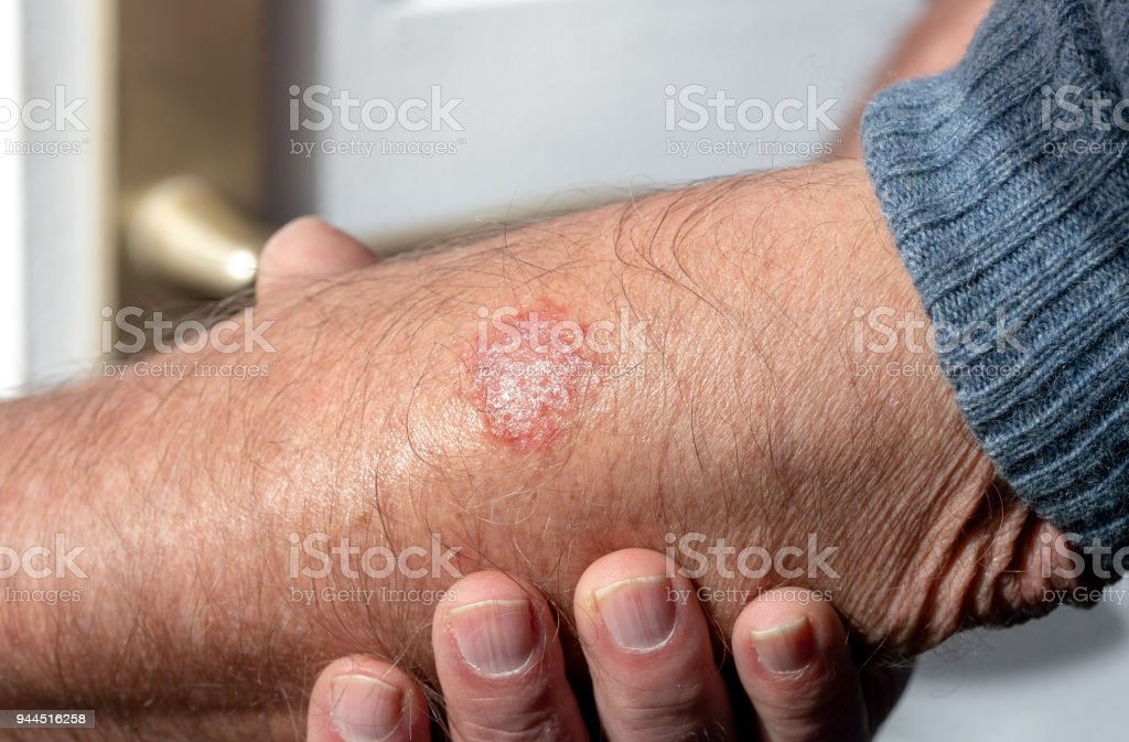 Eczema On The Arm Of A Man Close Up Stock Photo