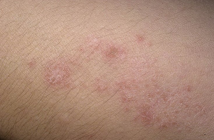Eczema on the Back Pictures  40 Photos &  Images ...