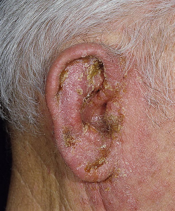 Eczema on the Ears Pictures  11 Photos &  Images ...
