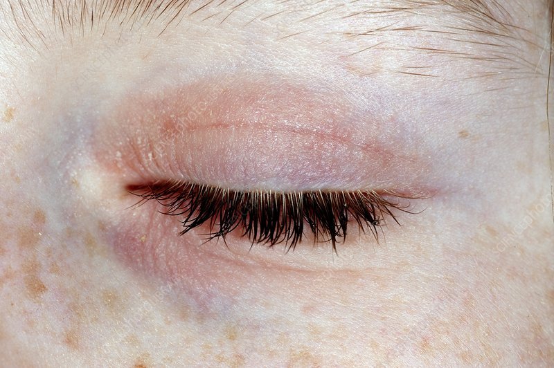 Eczema on the eyelid