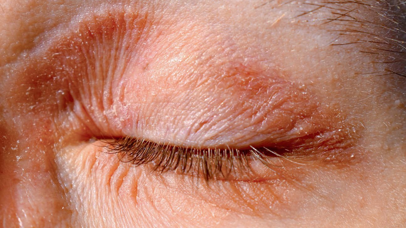 Eczema On The Eyes: Causes, Symptoms, and Treatment