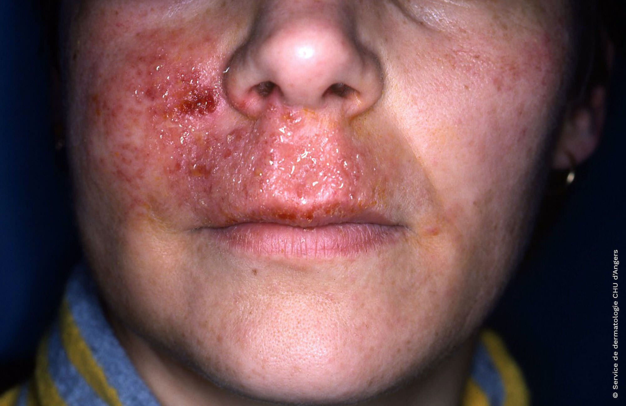Eczema on the face and neck