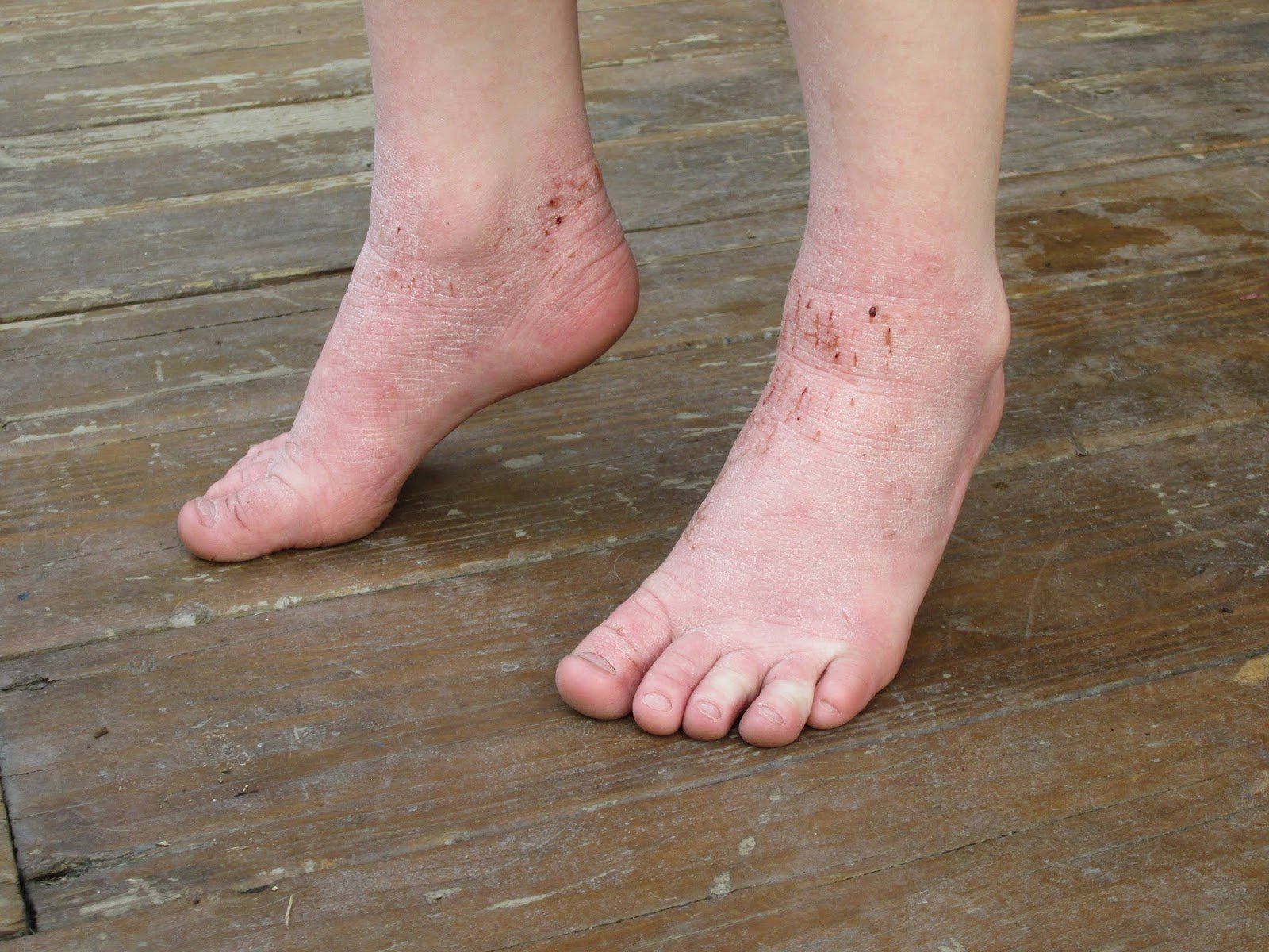 Eczema On The Feet: Types &  Treatments