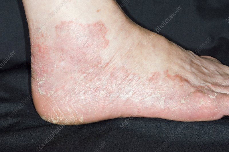 Eczema on the foot