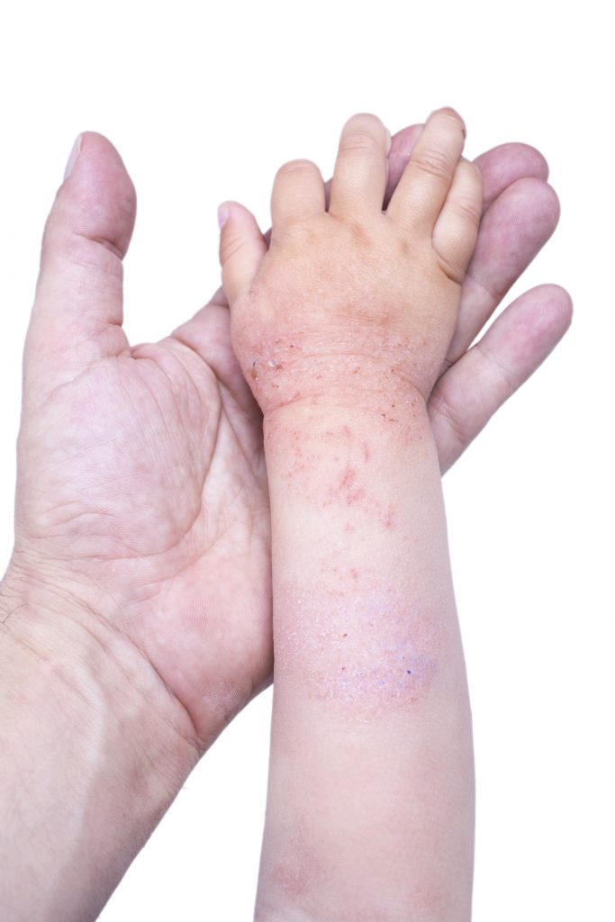 Eczema on the kid