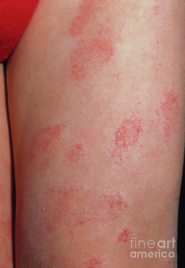 Eczema On The Leg Of A Child Photograph by Dr H.c.robinson/science ...