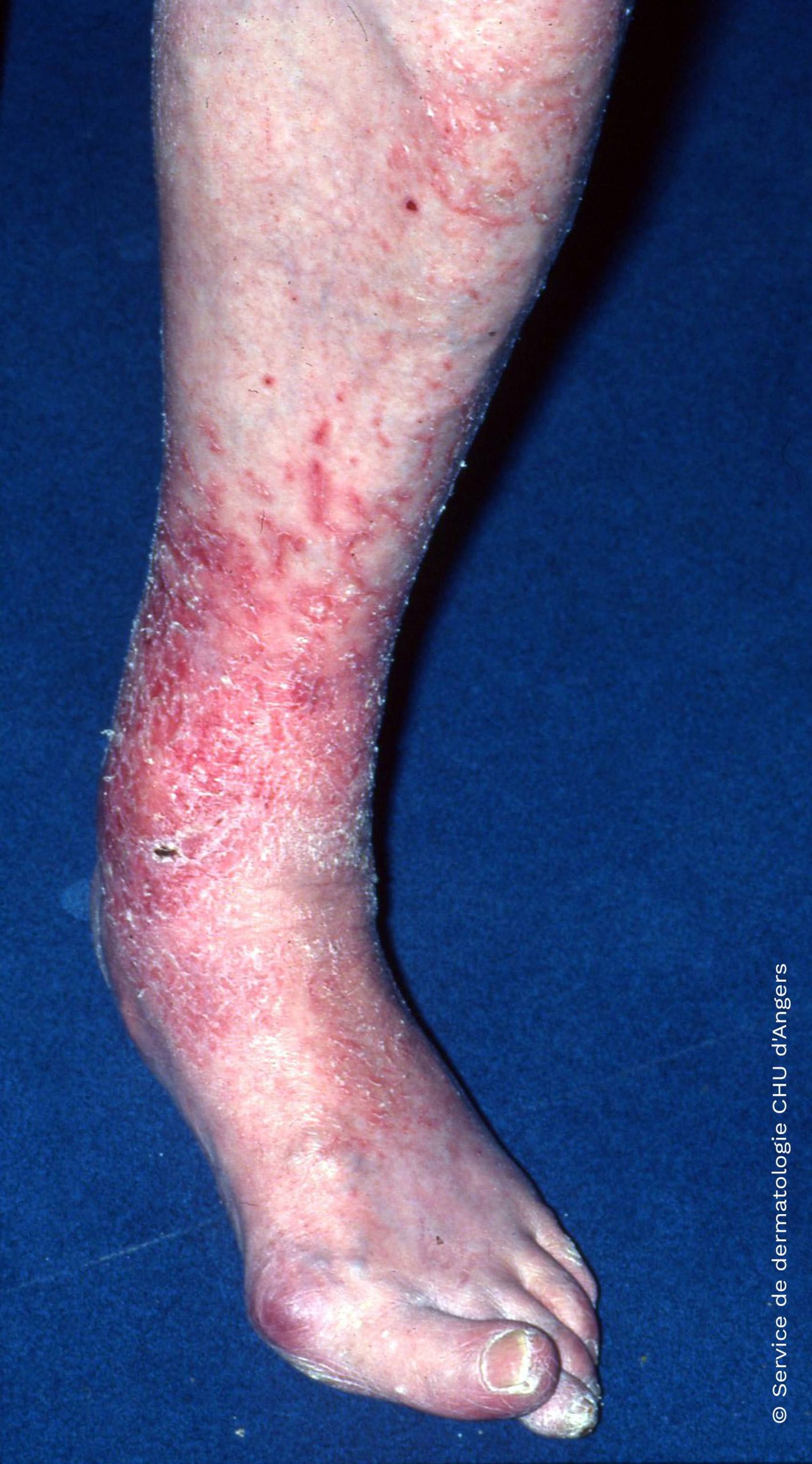 Eczema on the legs