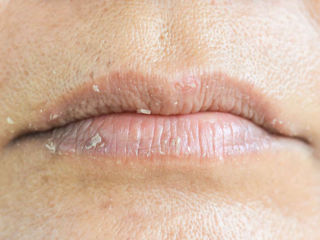 Eczema on the lips: Types, triggers, causes, and treatment ...
