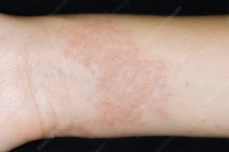 Eczema on the wrist