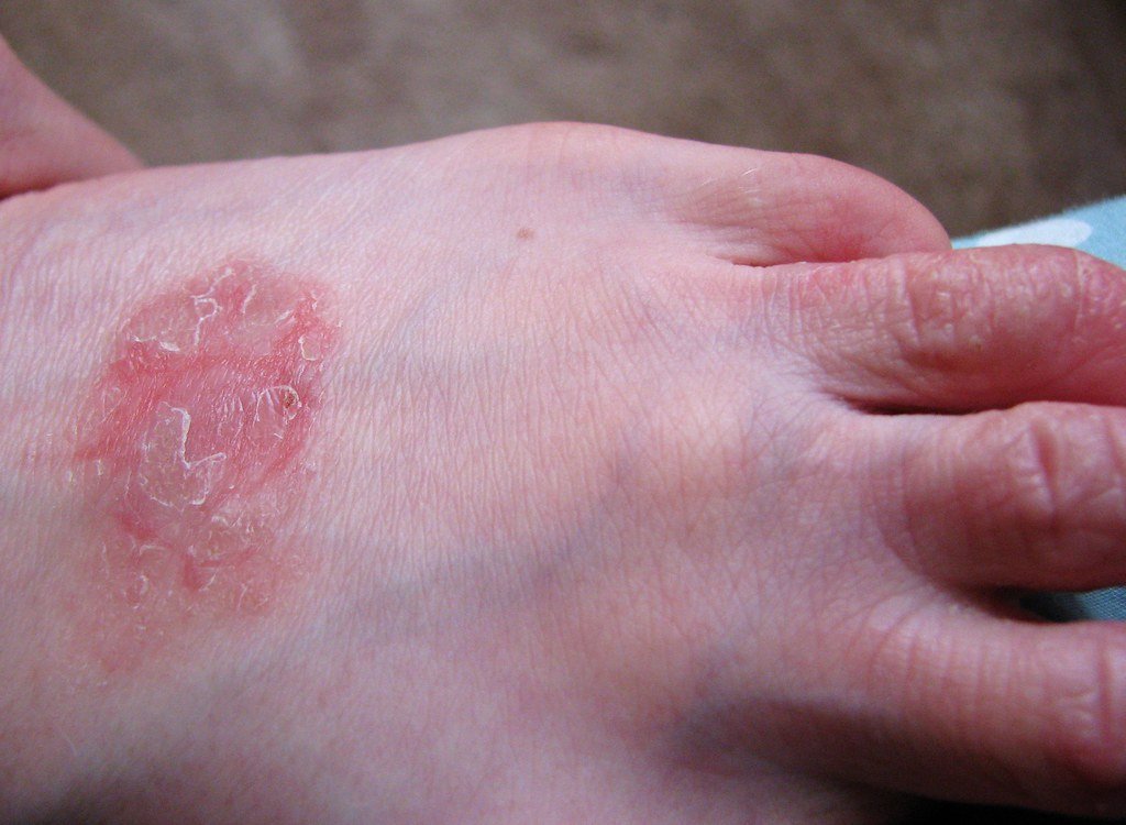 Eczema on top of foot