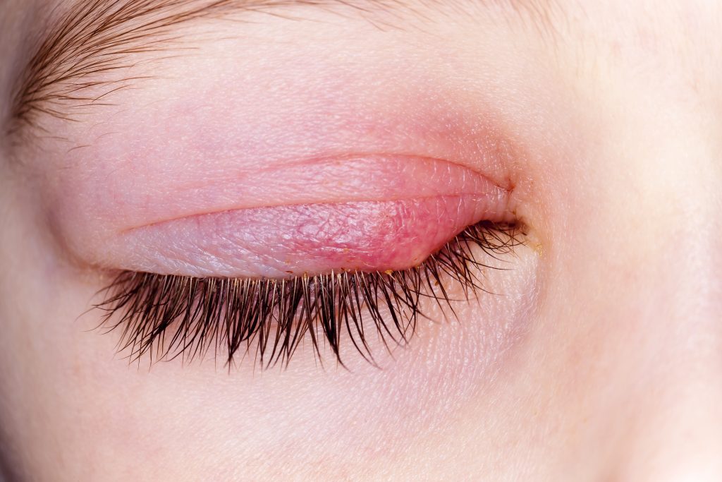 Eczema On Your Eyelids