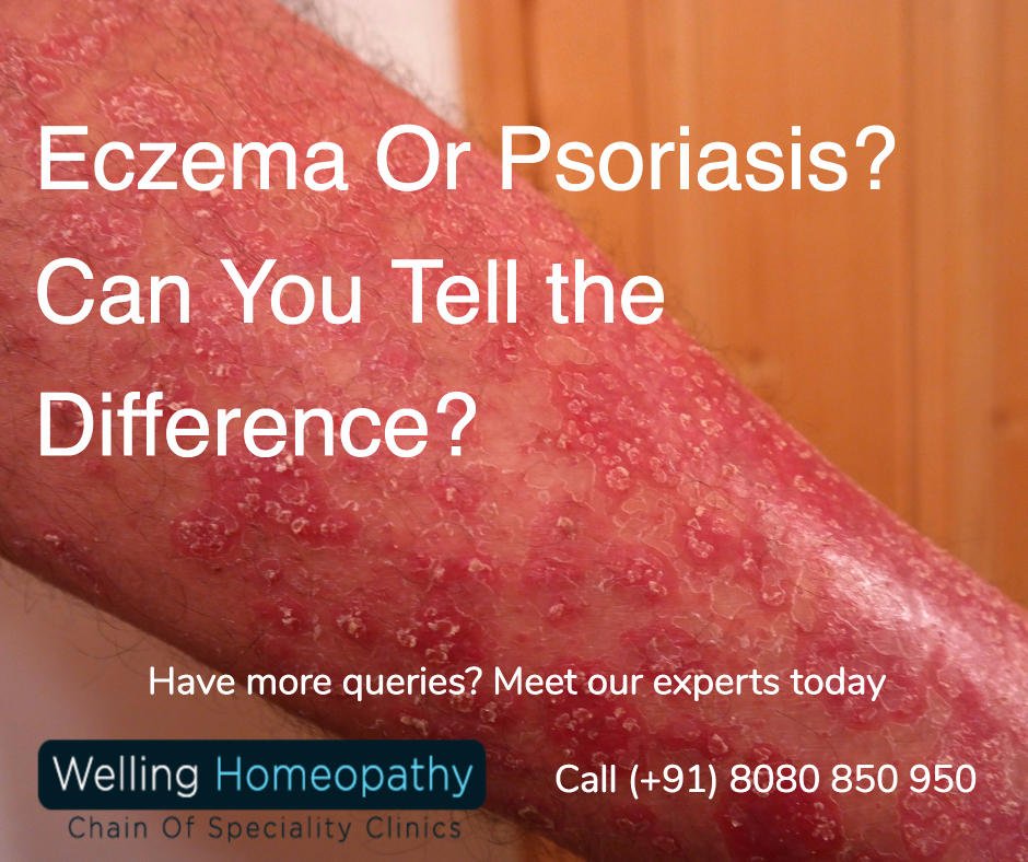 Eczema Or Psoriasis: Can You Tell the Difference?