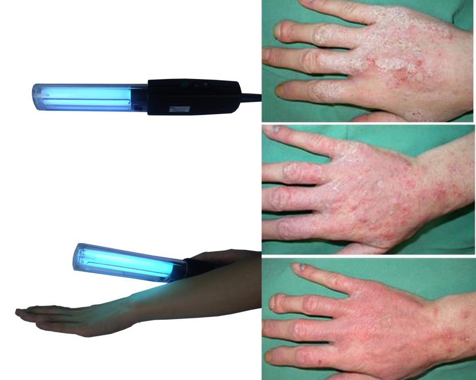 Eczema Phototherapy Hand