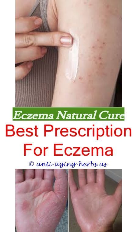 eczema pictures chronic hand eczema uvb tanning beds for eczema.eczema ...
