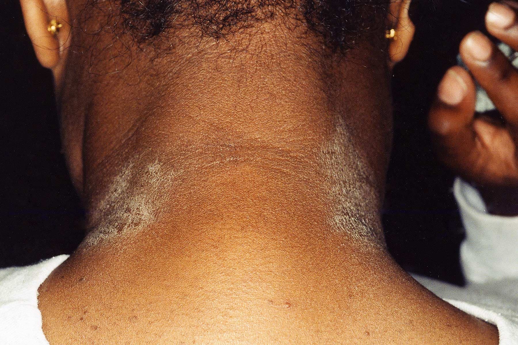 Eczema Pictures: What an Eczema Rash Looks Like