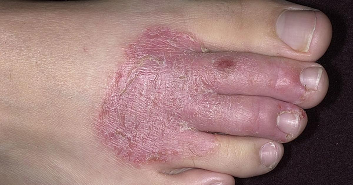 Eczema Pictures: What does Eczema look like?