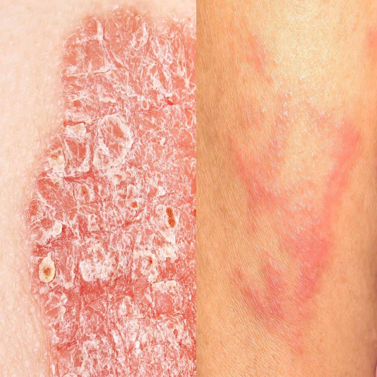 Eczema &  Psoriasis Archives