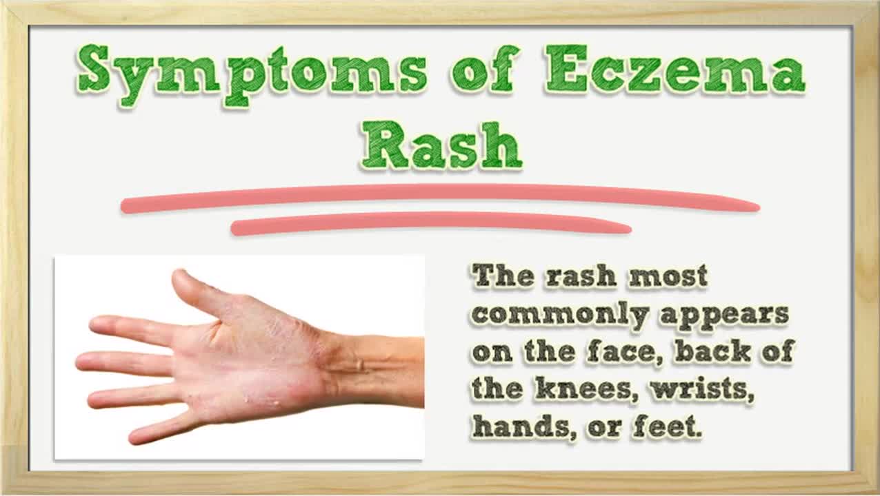 Eczema Rash