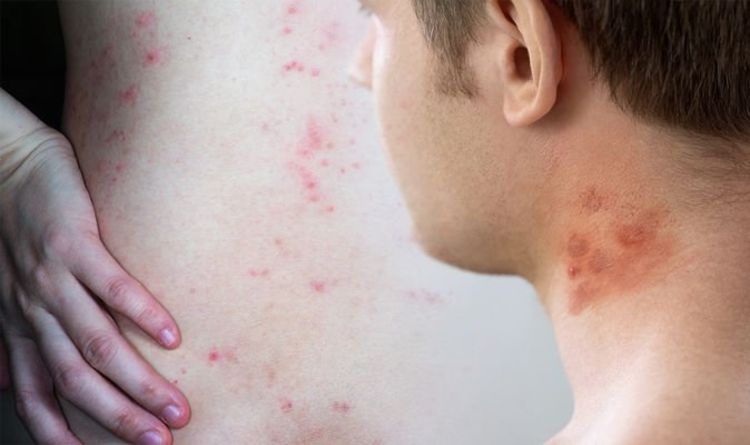 Eczema rash: Pus