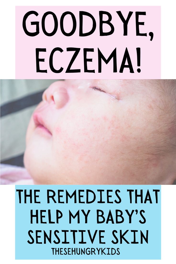 Eczema remedies for babies