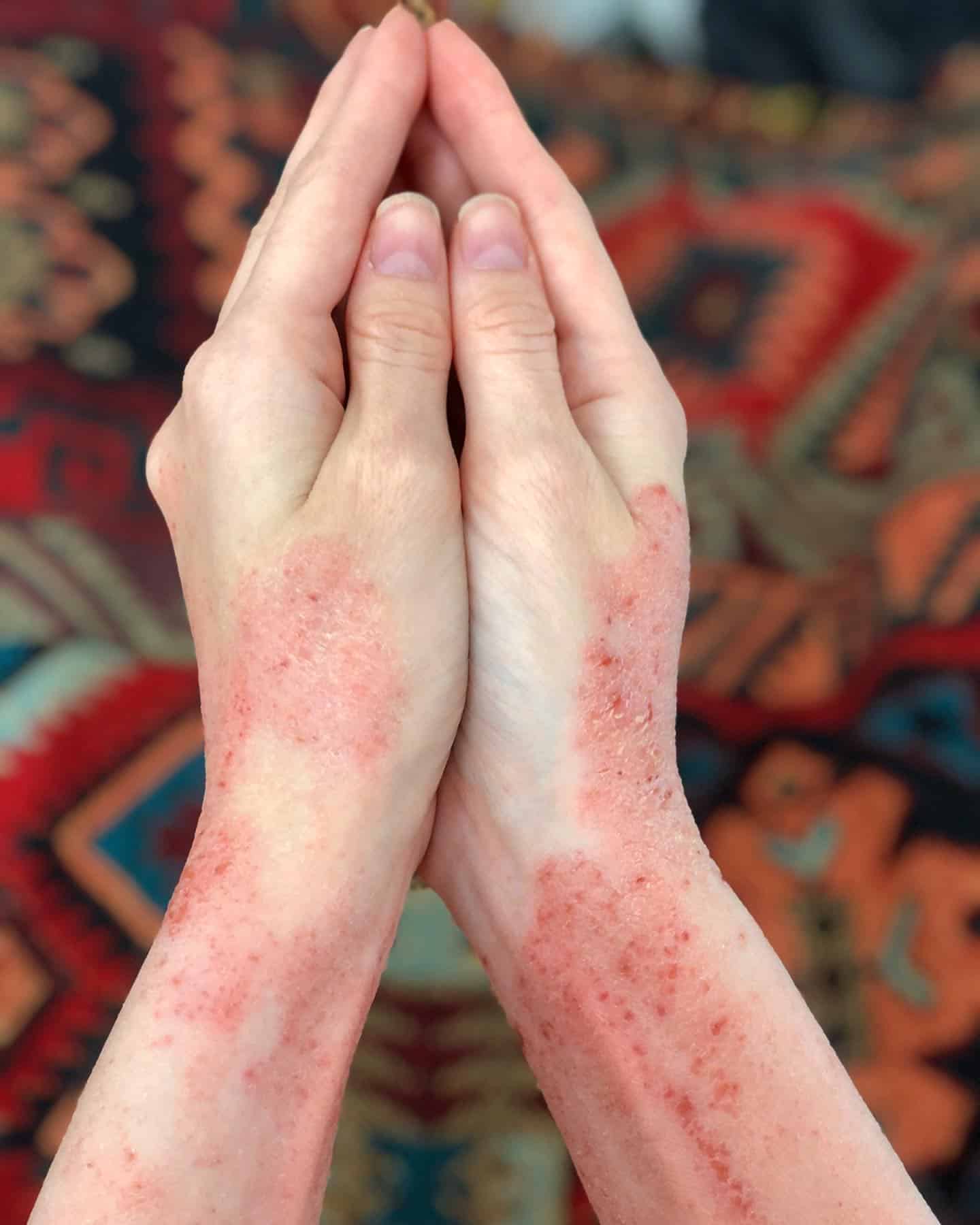 Eczema Scars: All you need to know