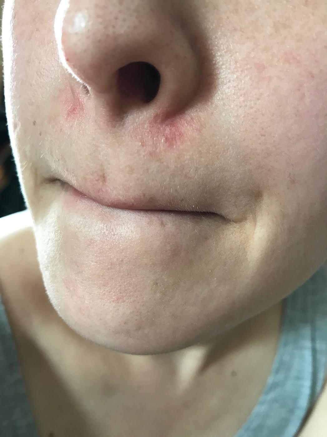 eczema: Seborrheic Eczema Nose