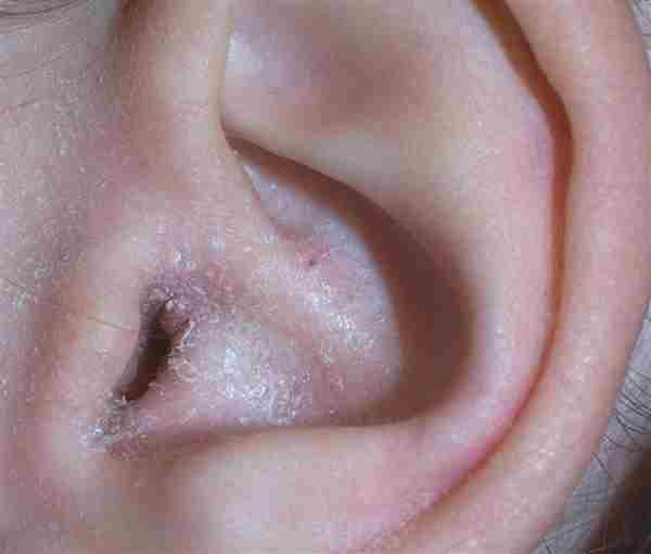 Eczema Severe Drying Out Of Skin Dermatitis Ear Canal