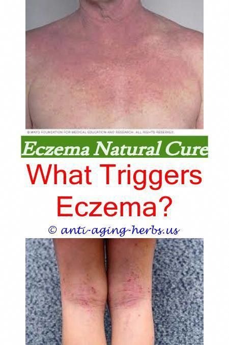 eczema: Severe Eczema Armpits