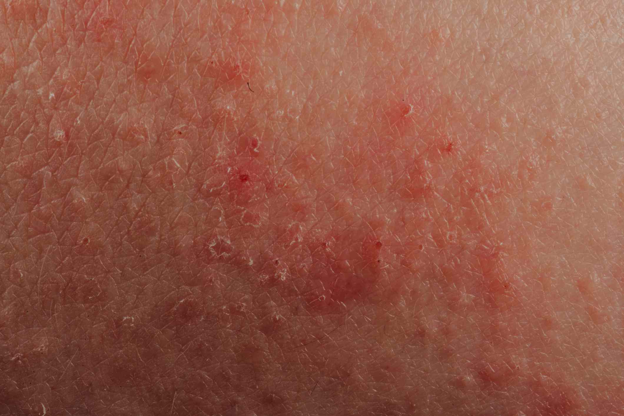 Eczema: Signs, Symptoms, and Complications