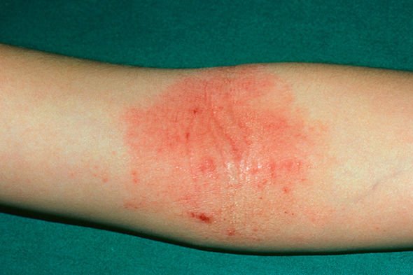 Eczema: Six tips on how to manage the itchy skin condition ...